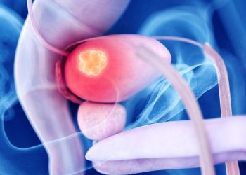 Cáncer de próstata