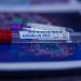 Pruebas diagnósticas coronavirus covid-19