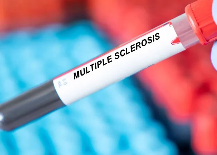 La esclerosis múltiple (EM), una enfermedad que afecta principalmente a la población de entre 20 y 59 años en Latinoamérica.