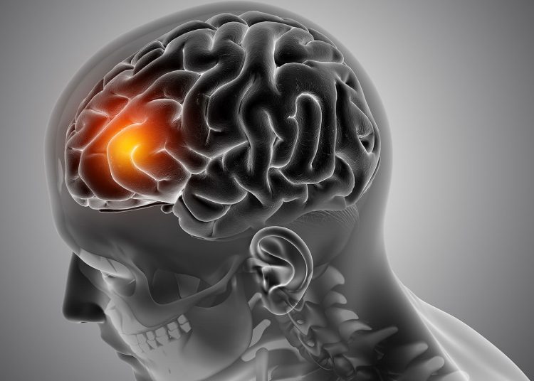 El número de personas que sufren un derrame cerebral, mueren o quedan discapacitadas a causa de esta afección casi se ha duplicado en los últimos 30 años a nivel global. - Fuente externa.