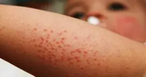 De acuerdo con Salud Pública, el país sigue libre de sarampión, rubeola y síndrome de rubeola congénita.